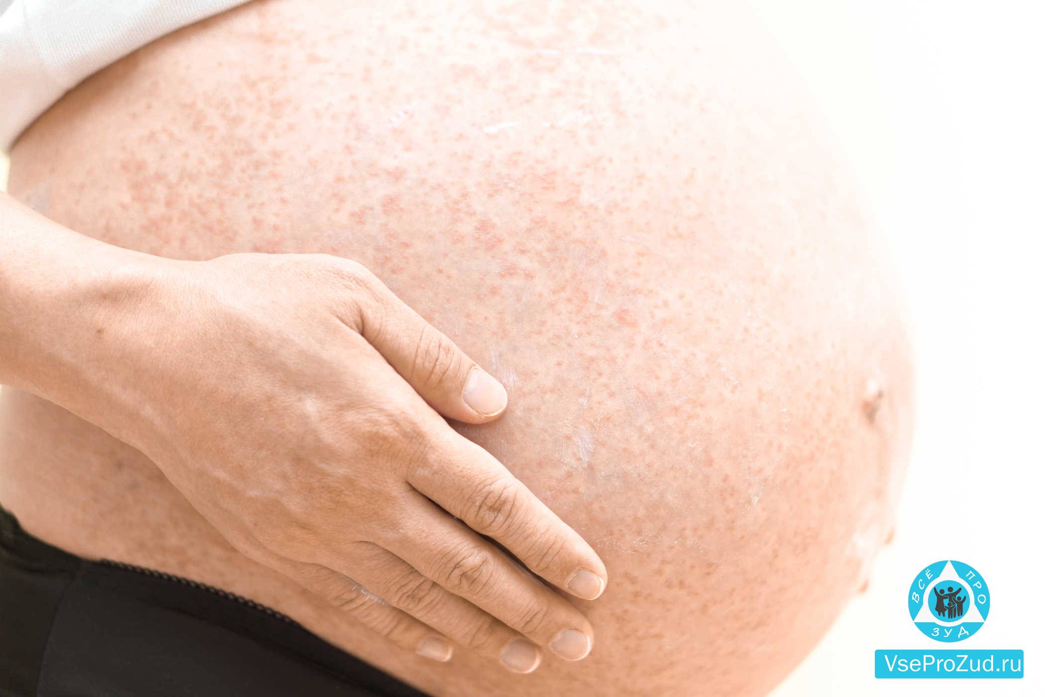 Корь при беременности: симптомы, осложнения, лечение