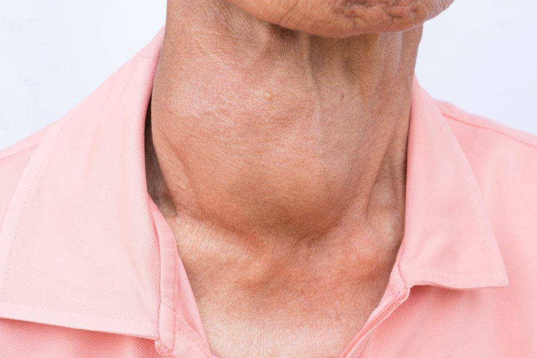 Проблемы с щитовидкой у мужчин: симптомы, признаки, лечение. основные симптомы заболевания щитовидной железы у мужчин
