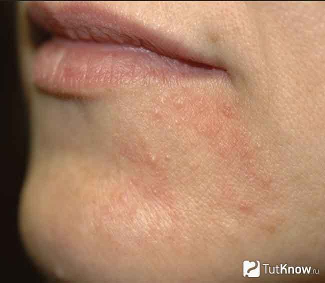 Раздражение на лице покраснение и шелушение. причины раздражения, шелушения и зуда лица, лучшие мази для лечения