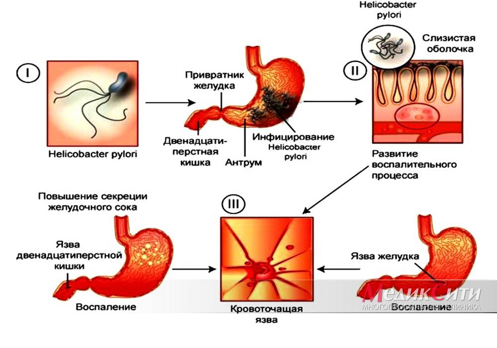 Helicobacter pylori diarrea y estreñimiento