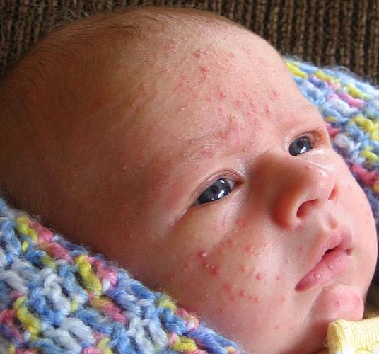 Аллергия на глютен: как проявляются симптомы у детей и взрослых