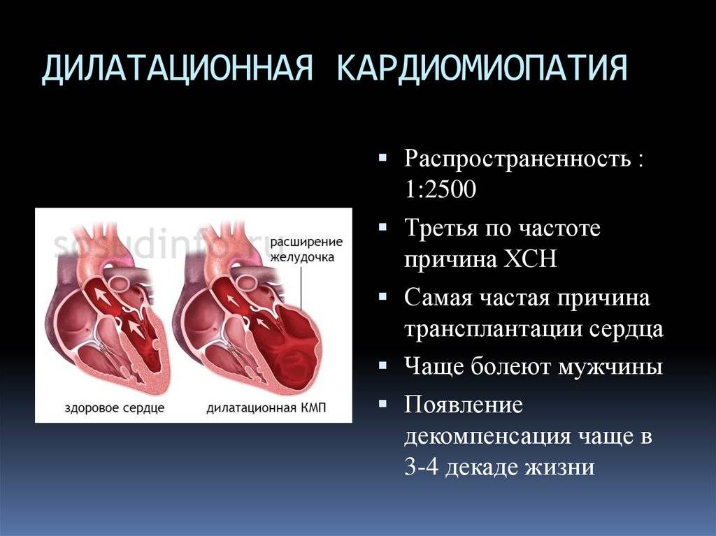 Миокард левого предсердия. Причины дилатационная кардиопатия. Клинические симптомы кардиомиопатии. Форма сердца при дилатационной кардиомиопатии. Осложнения дилатационной кардиомиопатии.