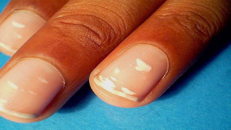 Белые пятна на ногтях: значение примет