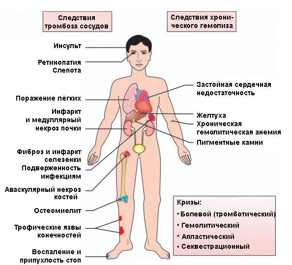 Симптомы серповидно-клеточной анемии