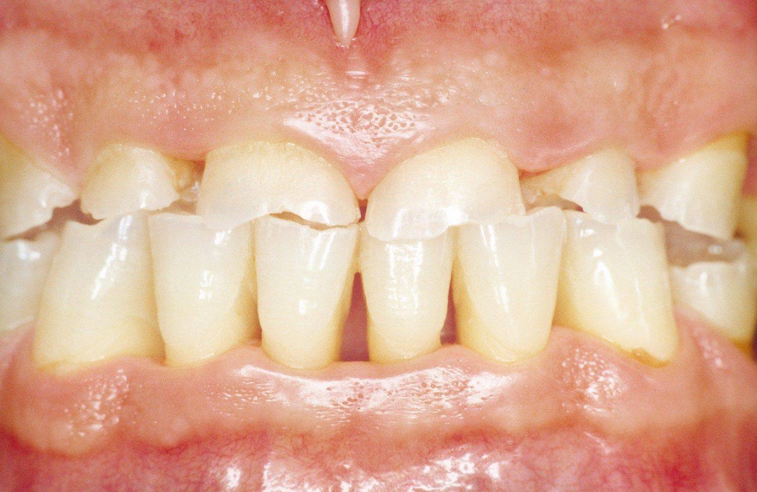 Бруксизм у взрослых причины и лечение: скрип (скрежет) зубами во сне. как как проводится лечение бруксизма в стоматологической клинике в москве || лесной
