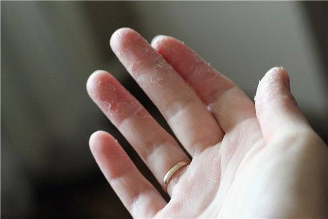 У ребенка на пальцах облазит кожа — почему шелушится кожа и что делать?