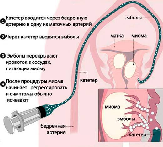 Эмболизация миомы матки: суть процедуры и возможные осложнения