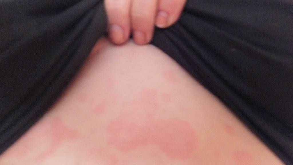 Аллергические высыпания на коже у взрослых и детей (фото): лечение сыпи