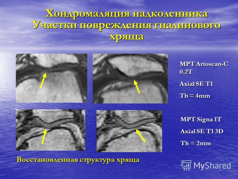 Хондромаляция коленного сустава 3 степени: лечение в клинике стопартроз в москве