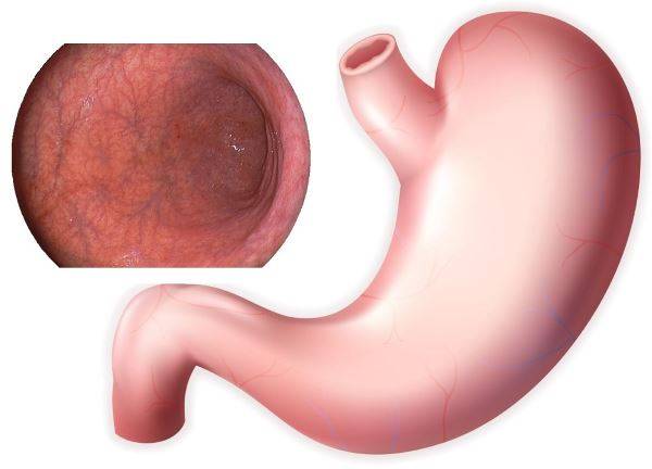 Нормализация структуры слизистой оболочки желудка при хроническом гастрите