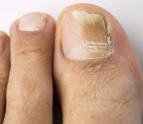 Как выглядит грибок на ногтях ног: подробные фото, эффективные средства лечения