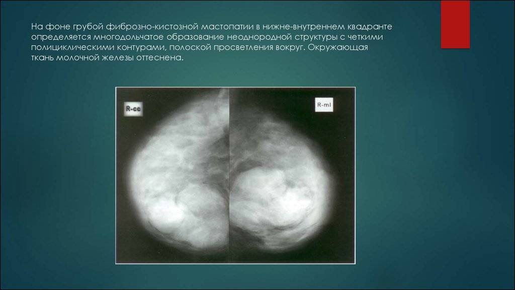 Признаки фиброзных изменений молочных желез. Узловая форма ФКМ молочной железы маммография. Маммография фиброзно кистозная мастопатия снимки. Фиброзная мастопатия маммограмма. Диффузная мастопатия молочной железы рентген.