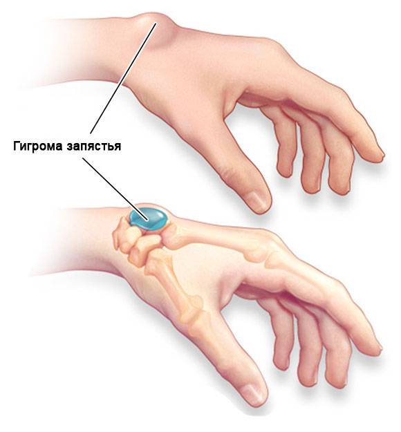 Гигрома (шишка) запястья: причины и лечение без операции твердой шишке на кисти руки, как лечить нарост с внутренней стороны если появился
