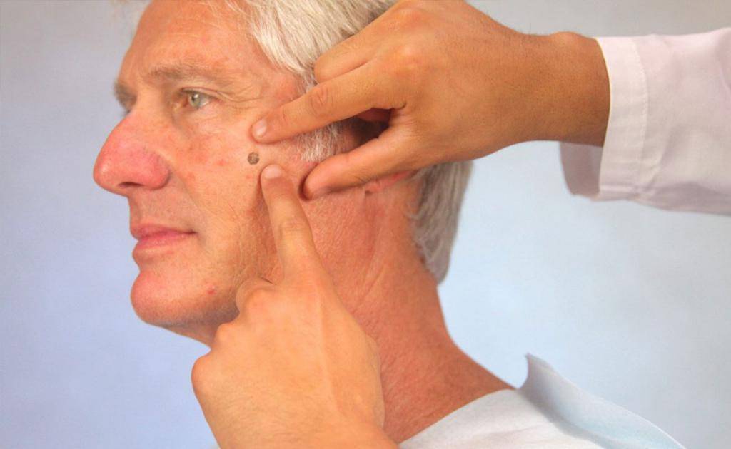 Себорейный кератоз мкб 10. кератома кожи — симптомы и лечение у взрослых, фото на лице, голове