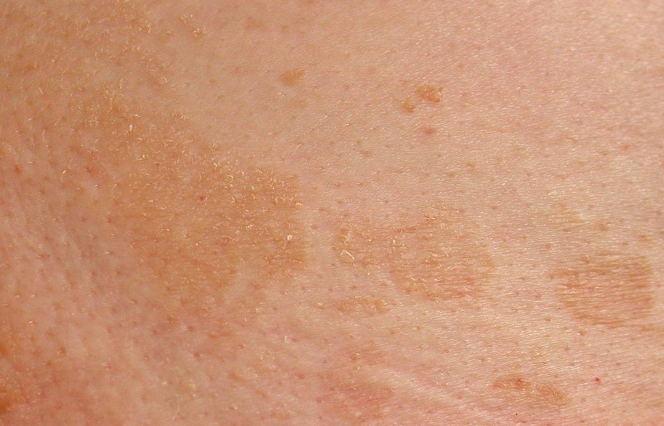 Коричневые пятна на теле: фото, причины, лечение | заболевания кожи
