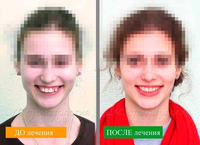 Брекеты: фото до и после исправления неправильного прикуса зубов, изменение лица