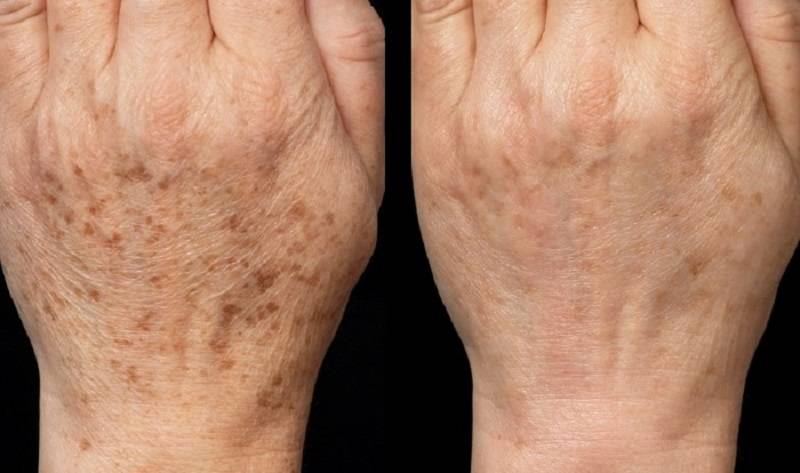 Старческие пятна на руках - как избавиться и как вывести на лице, причины пигментных у пожилых людей, чем отбелить, маска и средства