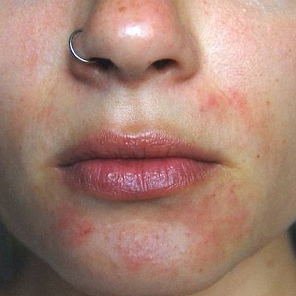 Пероральный дерматит на лице у ребенка фото лечение