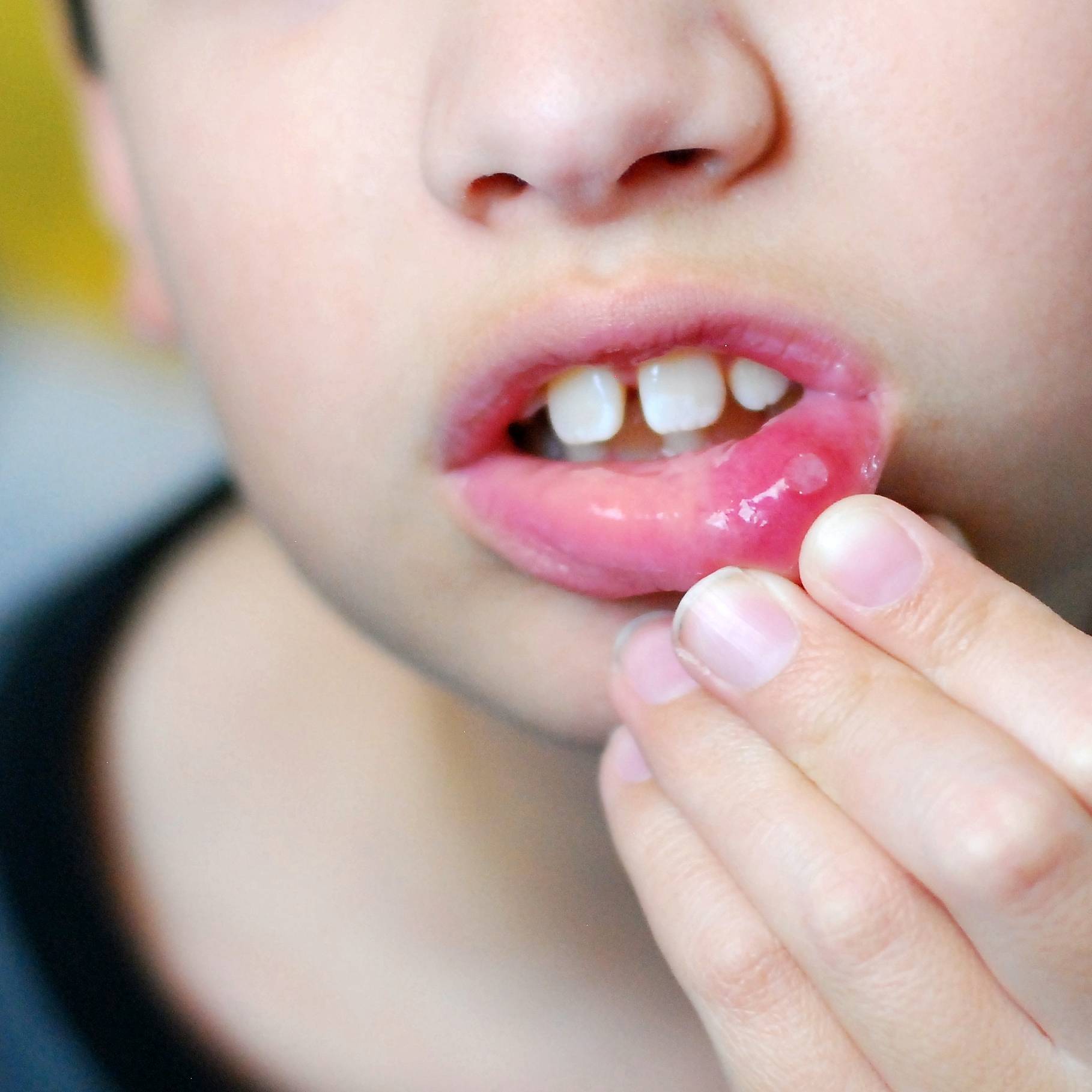 Кандидозный стоматит у взрослых во рту: симптомы, лечение, фото