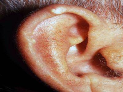 Почему болят ушные раковины ночью при лежании на ухе