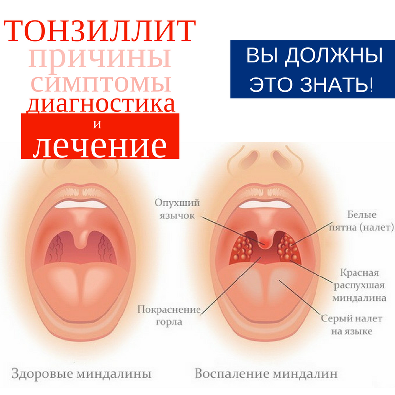 Герпесная ангина у детей и взрослых: фото, симптомы и лечение | pro-herpes.ru