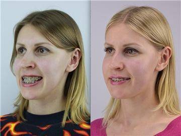 Дистальный прикус, фото до и после брекетов, исправление и лечение мезиальной, глубокой неправильной формы зубов у взрослых