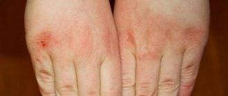 Раздражение, покраснение между пальцами рук: причины, чем лечить