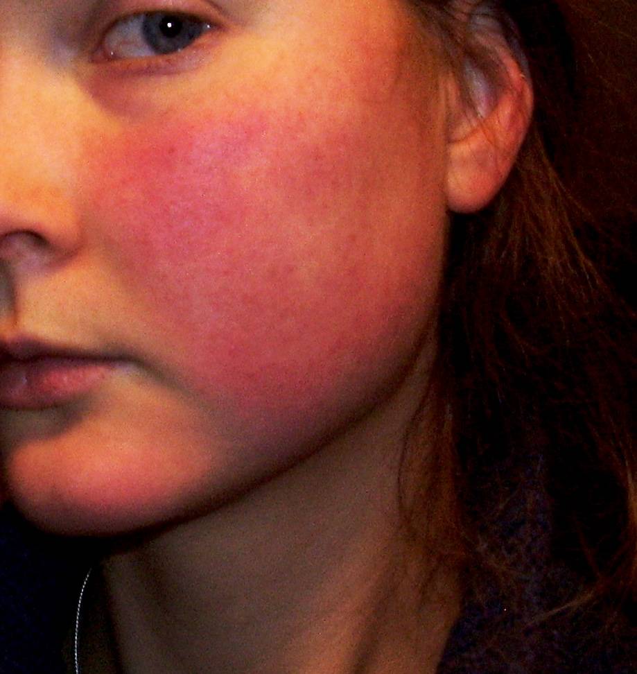 Почему у взрослого красные щеки: основные причины, лечение | fok-zdorovie.ru