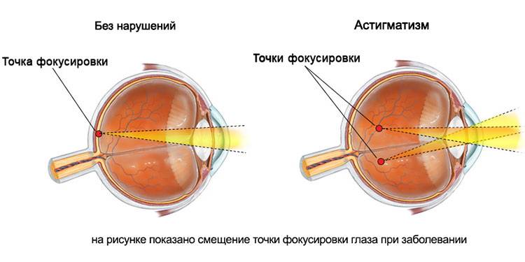Астигматизм глаз