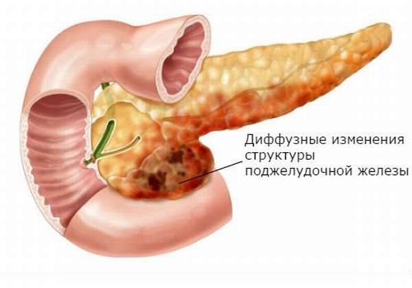 Диффузные изменения печени и гепатомегалия при заболеваниях поджелудочной железы