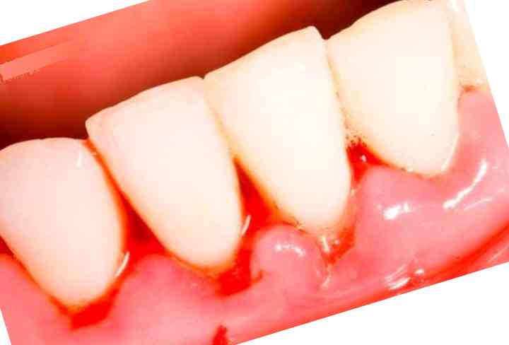 Почему кровоточат десна при чистке зубов? советы по профилактике и лечению