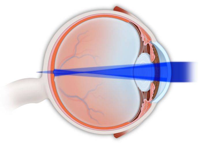 Врач поставил мне диагноз астигматизм — что это за патология и как вернуть зрение?