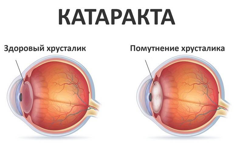 Лечение катаракты народными средствами — отзывы вылечившихся