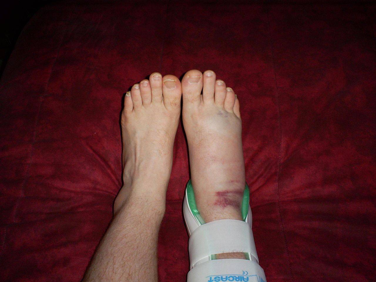 Сколько заживает перелом пальца на ноге без гипса