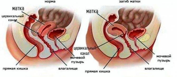Ретрофлексия матки: причины, симптомы, лечение