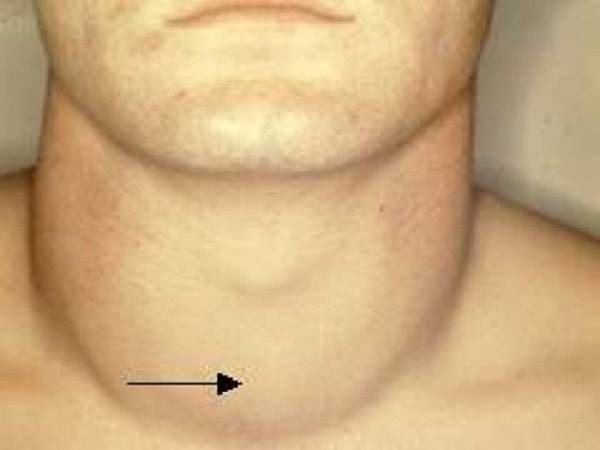 Как устроена щитовидная железа у мужчин: симптомы заболевания, лечение, удаление, норма