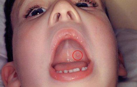 Лечение герпетического стоматита у детей