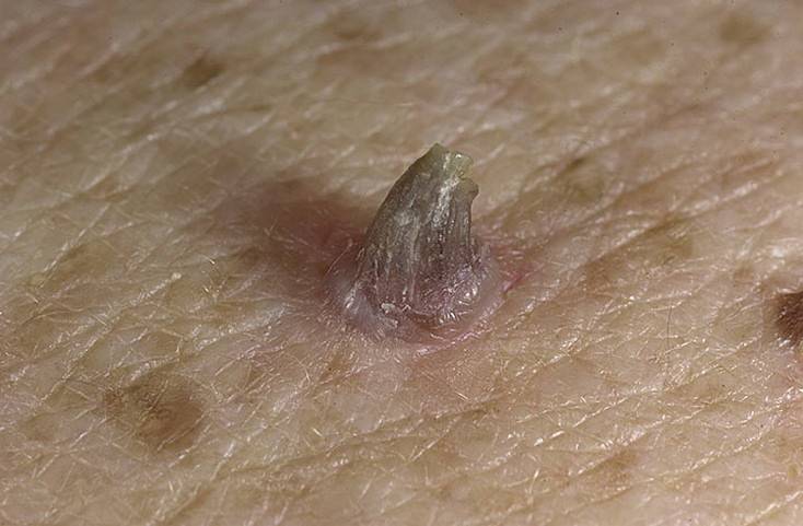 Себорейный кератоз код мкб 10. кератоз кожи: фото, лечение, типы и виды. противопоказания к лазерному удалению