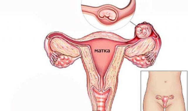 Гипоплазия матки: что это такое, как лечить, можно ли забеременеть