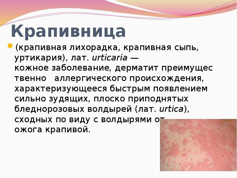 Демографическая крапивница: фото, симптомы, причины, лечение, профилактика | fr-dc.ru