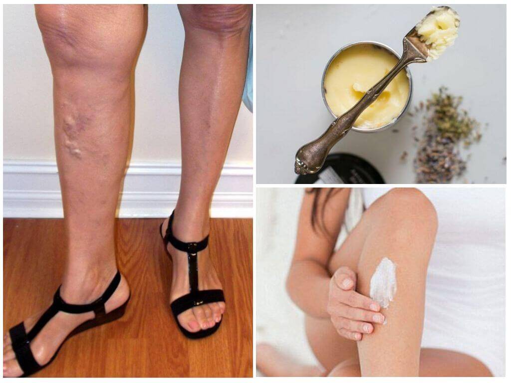 Варикозное расширение вен на ногах: лечение в домашних условиях, народные средства