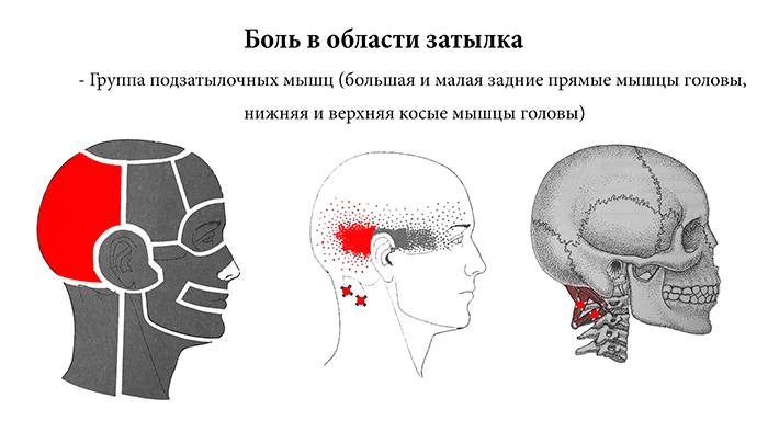 Причины и помощь при боли в затылке у основания черепа. болит шея у основания черепа возможные симптомы и что делать