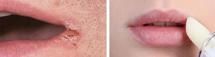 Красные уголки губ — почему появляется хейлит и как его лечить?