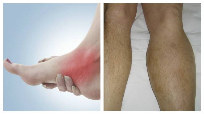 Почему тянет ногу от ягодицы до стопы: лечение тянущей боли в правой и левой ноге