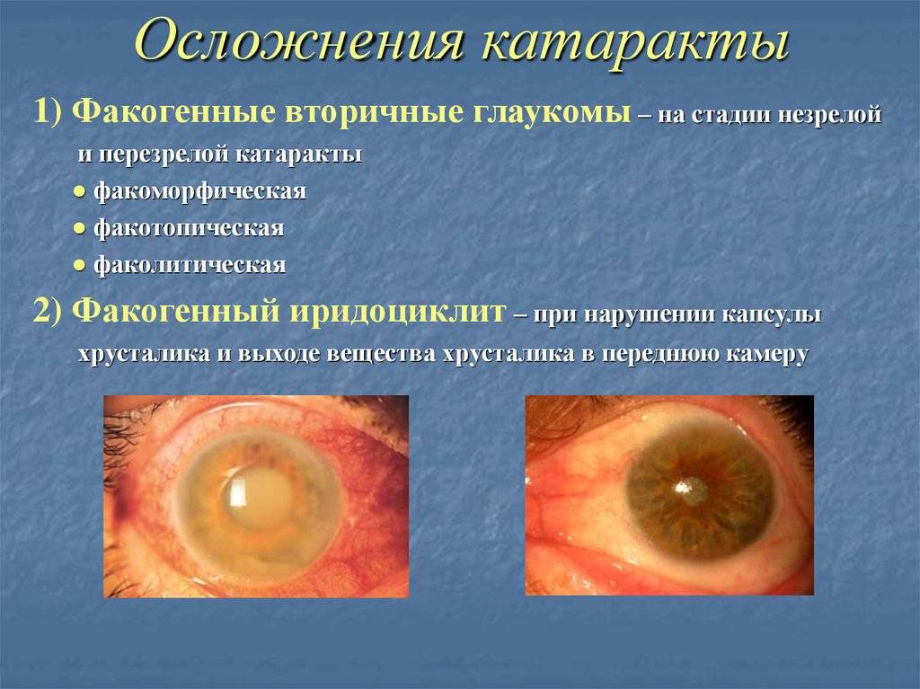 Лечение катаракты народными средствами