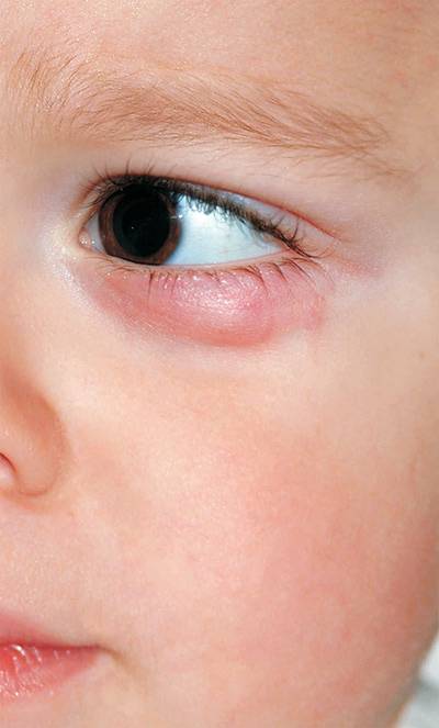 Ячмень на глазу у ребенка: как лечить в домашних условиях