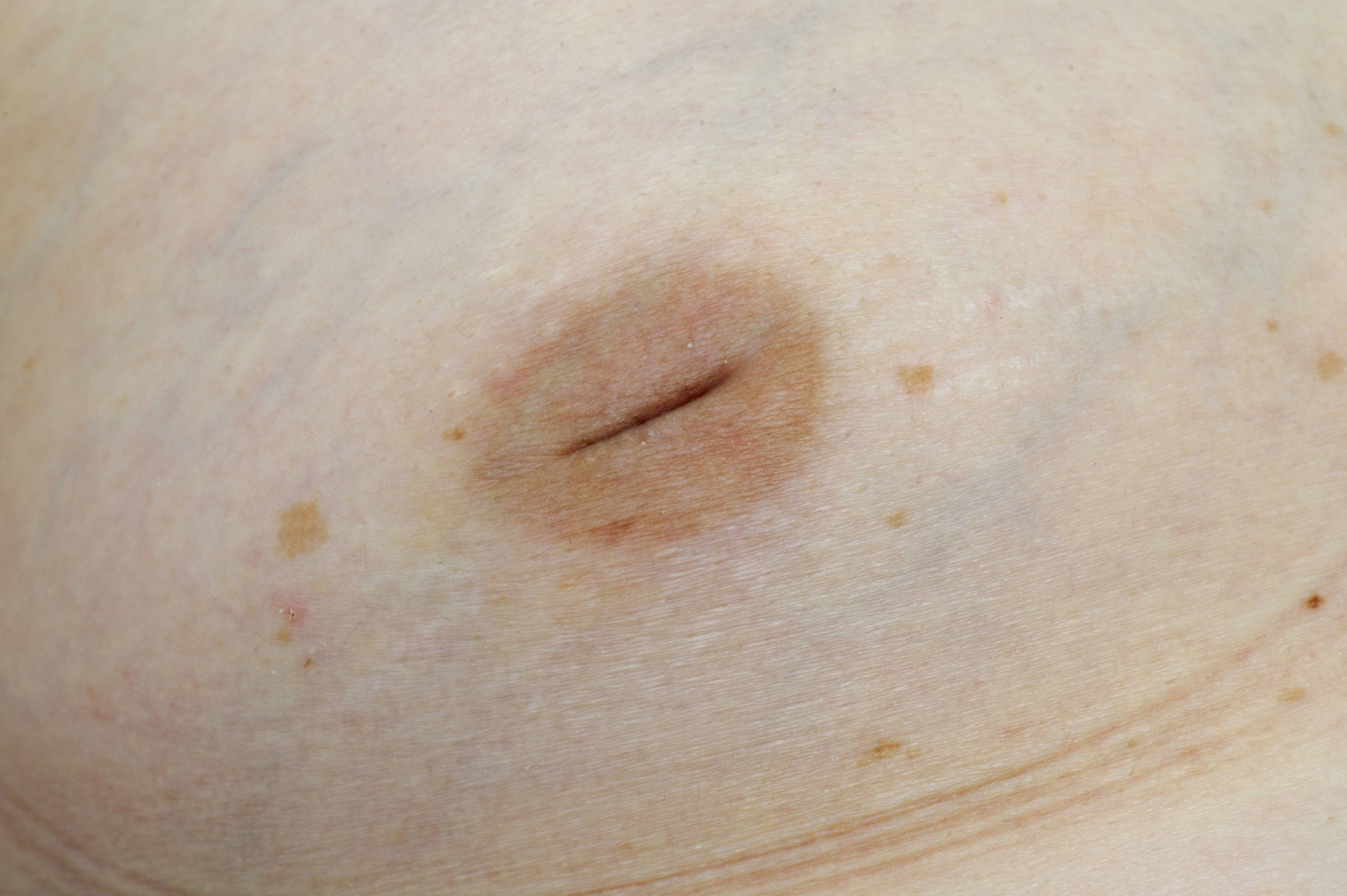 Причины и виды выделений из груди желтого цвета при надавливании — портал о заболеваниях груди