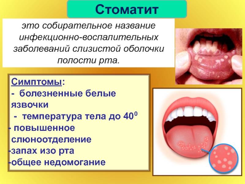 Вирусные заболевания слизистой оболочки полости рта — зубы