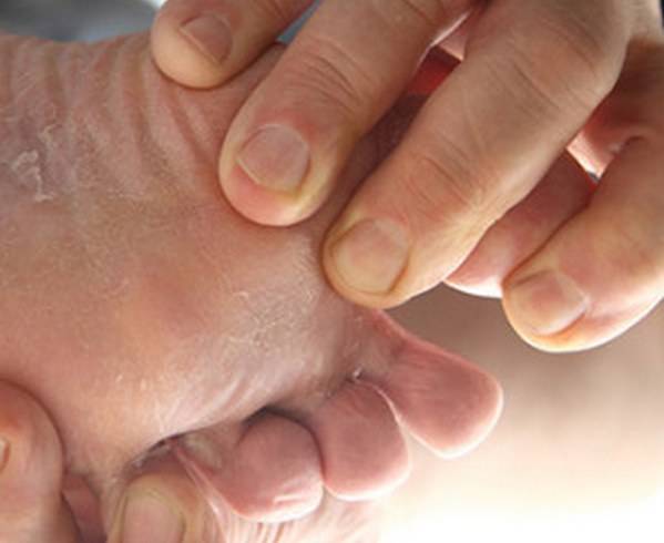 Как вылечить грибок между пальцами ног в домашних условиях
