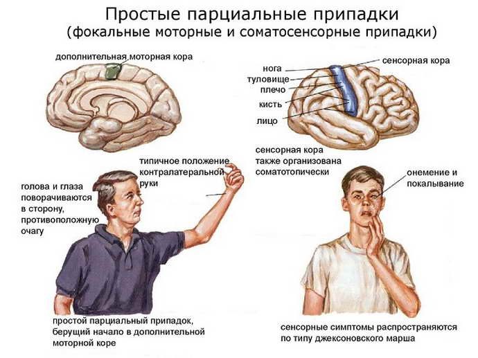 Генерализованная эпилепсия: идиопатическая и вторичная форма синдрома